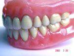 dents porcelaine resine ordinaire