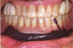 Le patient doit serrer les dents pour mettre la prothèse en position fonctionnelle.