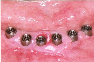 Quatre mois après la chirurgie, six piliers sont connectés aux implants