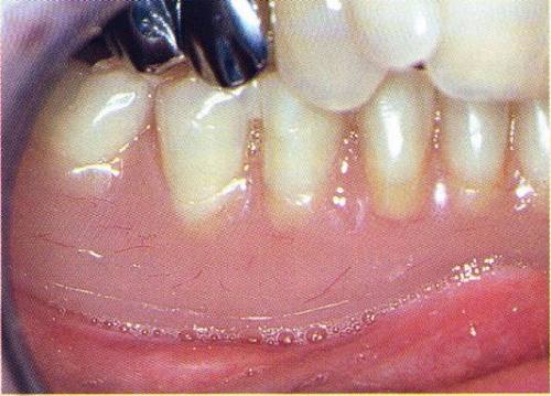 La prothèse d'usage en bouche (Vertex)