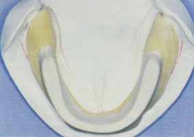PEI mandibulaire avec un bourrelet préfigurant l'arcade dentaire situé dans l'aire de Pound  et qui offre ainsi un soutien optimal  à la musculature périphérique et linguale.