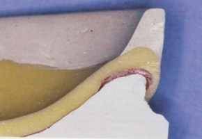 PEI en coupe sagittale médiane espacé au niveau du tissu hyperplasique et ajusté ailleurs
