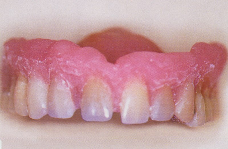 Adjonction extemporanée de quatre dents antérieures et extension de la base dans la zone vestibulaire avec une résine autopolymérisante au fauteuil